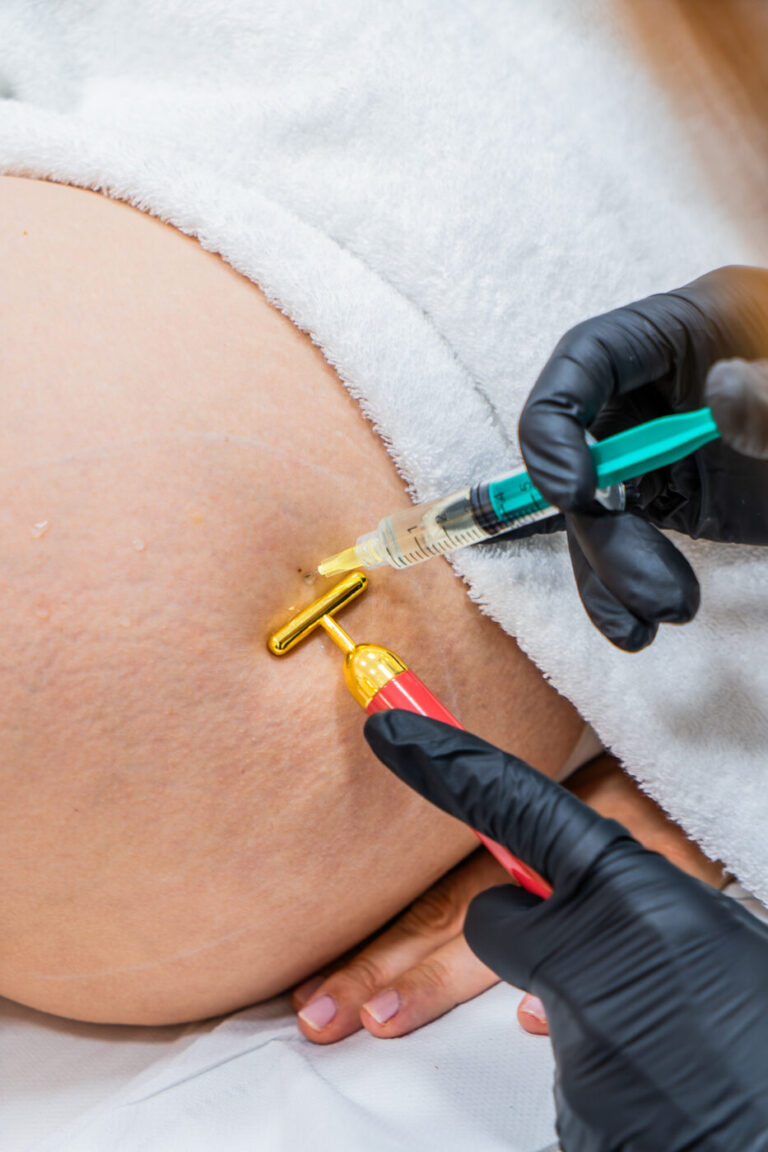 Mesoterapia lipolítica