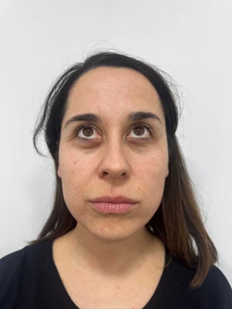 Melasma